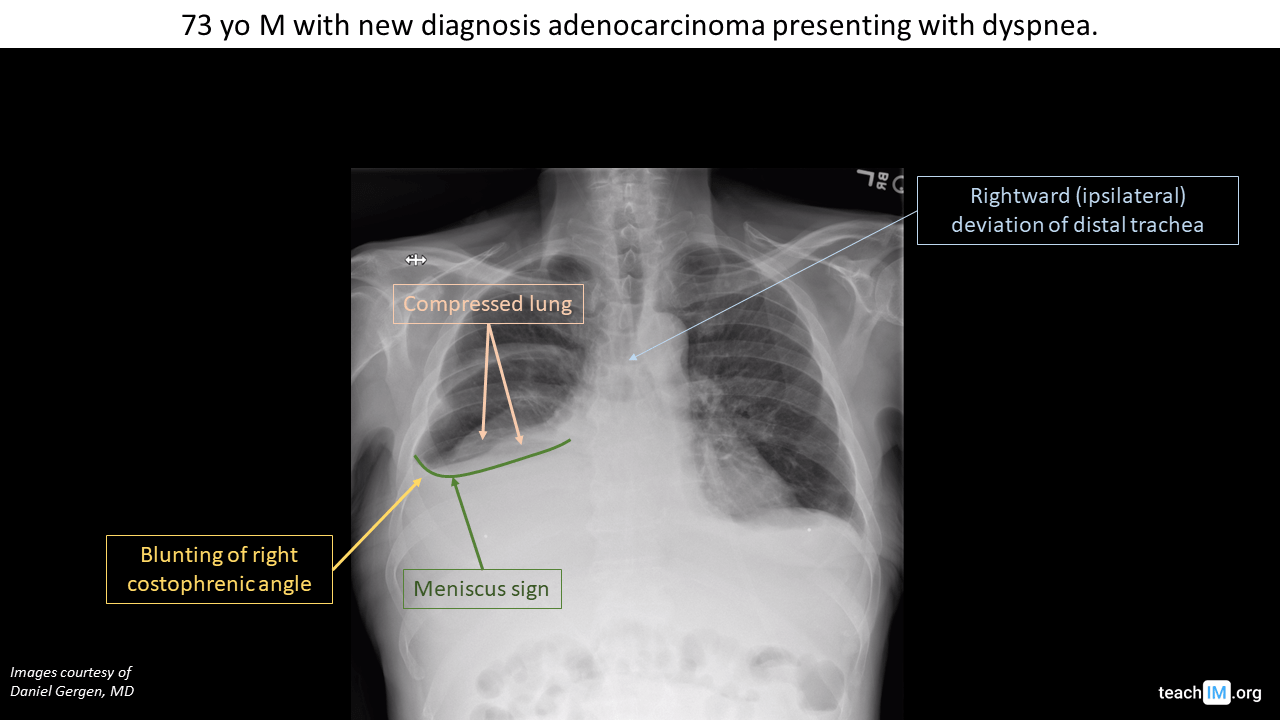 Fluid Around the Lungs (Pleural Effusion): Overview, Causes, Diagnosis & Care