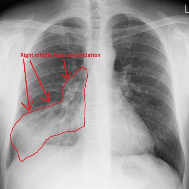 Pulmonary Aspiration: Overview, Causes, Symptoms, Diagnosis, and Treatment