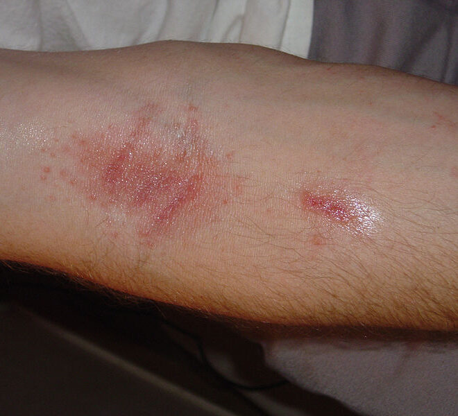 Poison Ivy Rash: Causes, Symptoms, Prevention, and Treatment