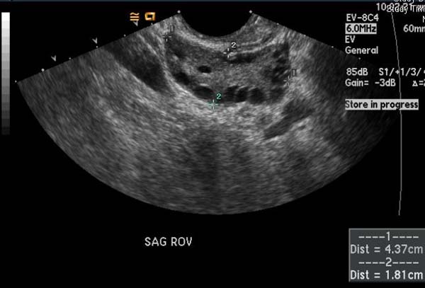 Polycystic Ovary Syndrome (PCOS): Overview, Symptoms, Causes & Treatments