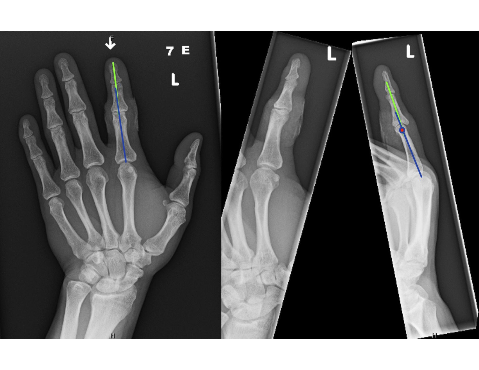 Joint Displacement: Types, Causes, and Treatments