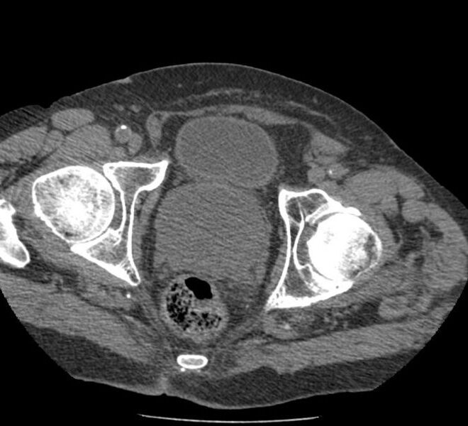 Enlarged Prostate (Benign Prostatic Hyperplasia): Overview, Causes, Symptoms & Care