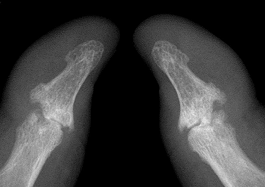 Psoriatic Arthritis: Causes, Symptoms, Diagnosis, and Treatments