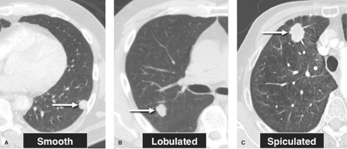 Lung Nodules: Overview, Types, Diagnosis, and Treatment Options