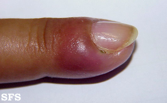 Nail Fold Infection (Paronychia): Causes, Symptoms, and Treatments