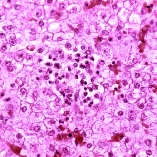 Reye’s Syndrome (Reye Syndrome): A Comprehensive Overview