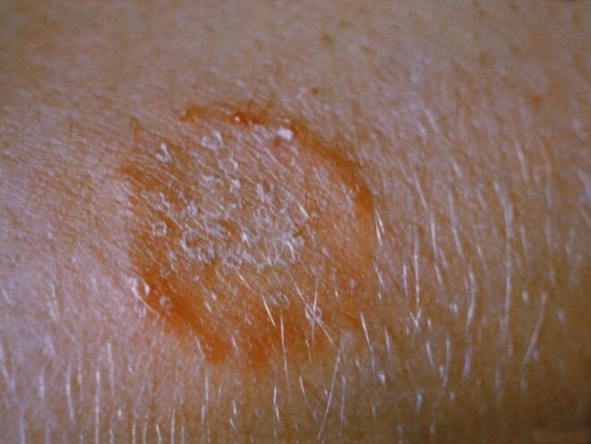 Ringworm: Causes, Symptoms, Types, and Treatments