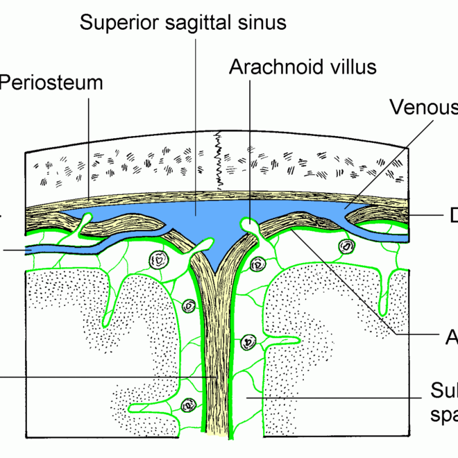 Bleeding in the Space Around the Brain (Subarachnoid Hemorrhage): Overview