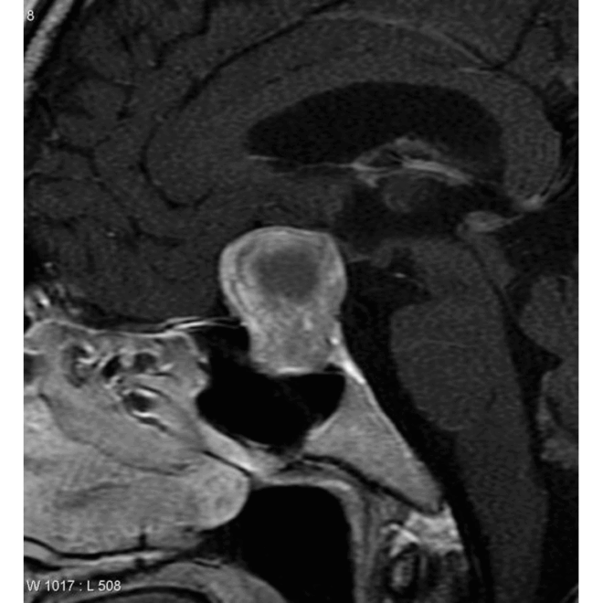 Prolactinoma: An Overview of Causes, Symptoms, and Treatments