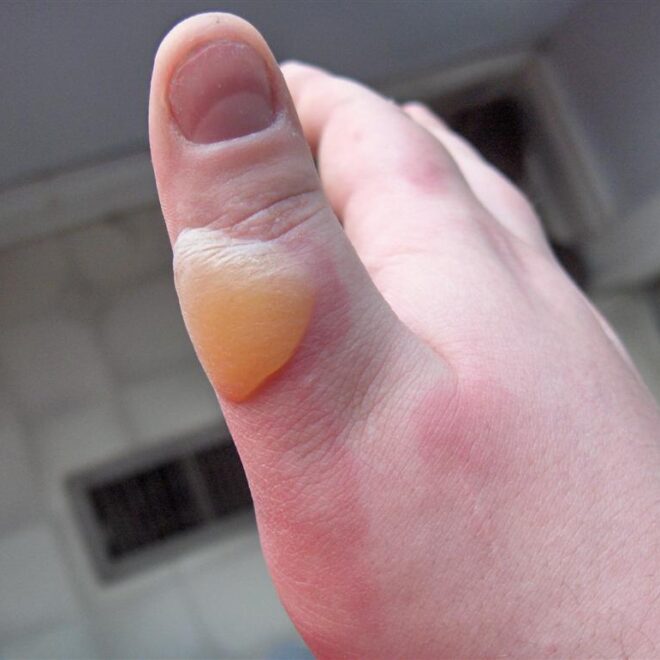 First Degree Burn: Causes, Symptoms, and Care