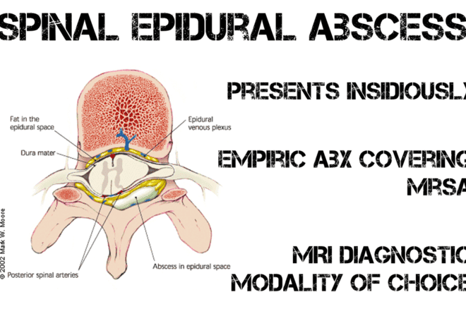 Abscess: Causes, Symptoms, Diagnosis, and Treatment