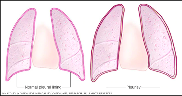 Pleurisy: What It Is, Causes, Symptoms & Treatment