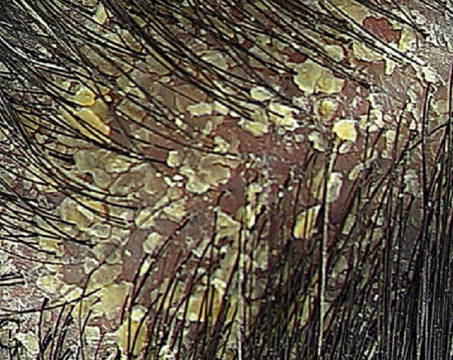 Cradle Cap (Seborrheic Dermatitis): Causes, Symptoms & Care