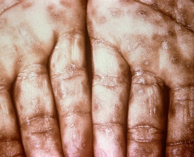 Nummular Dermatitis: Overview, Causes, Symptoms & Treatments