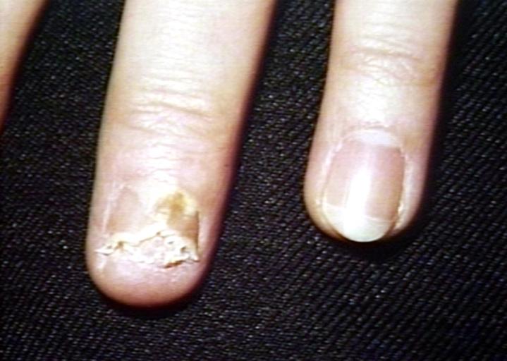 Warts: Types, Causes, Symptoms, and Treatments