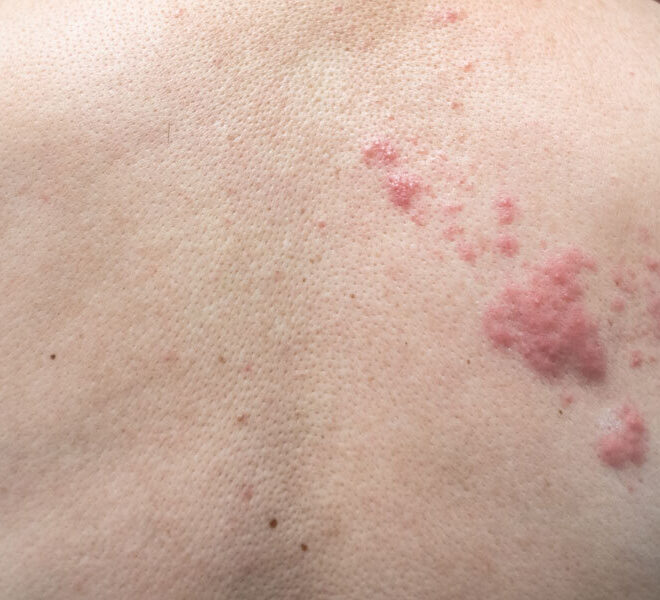 Shingles: Causes, Symptoms, Treatment, and Prevention