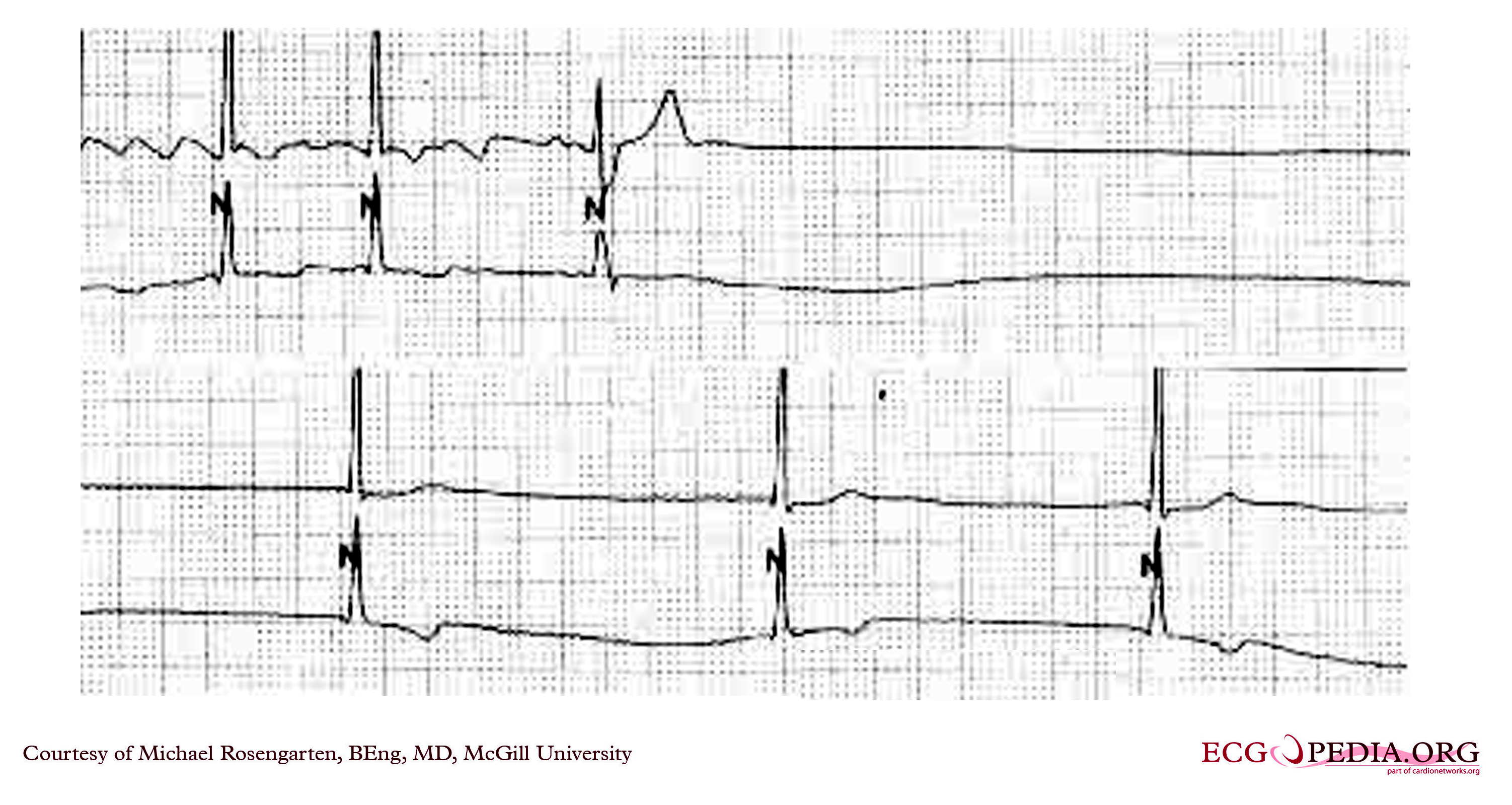 Sick Sinus Syndrome: Overview of Causes, Symptoms, and Treatments