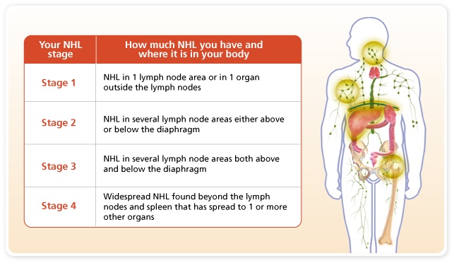 Non-Hodgkin Lymphoma (NHL): Types, Symptoms, Diagnosis, and Treatments