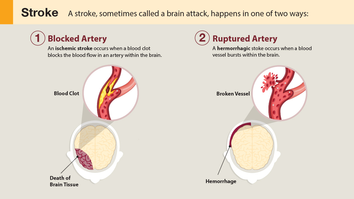 Stroke: What It Is, Types, Causes, Symptoms & Recovery