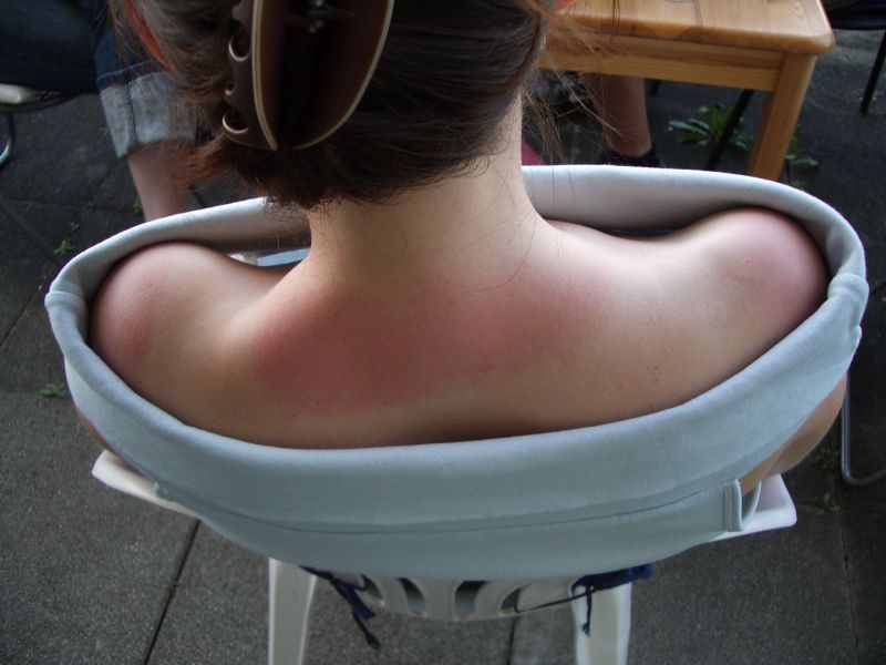 Sunburn: Causes, Symptoms, Prevention, and Treatment
