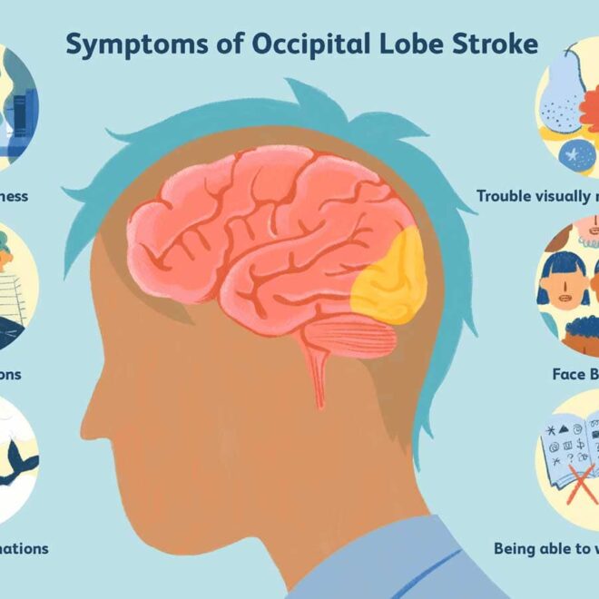 Bleeding in the Brain (Intracerebral Hemorrhage): Causes, Symptoms & Care