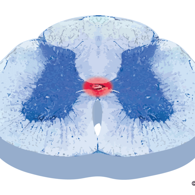 Syringomyelia: A Detailed Overview of the Spinal Cord Disorder (Syringomyelia)
