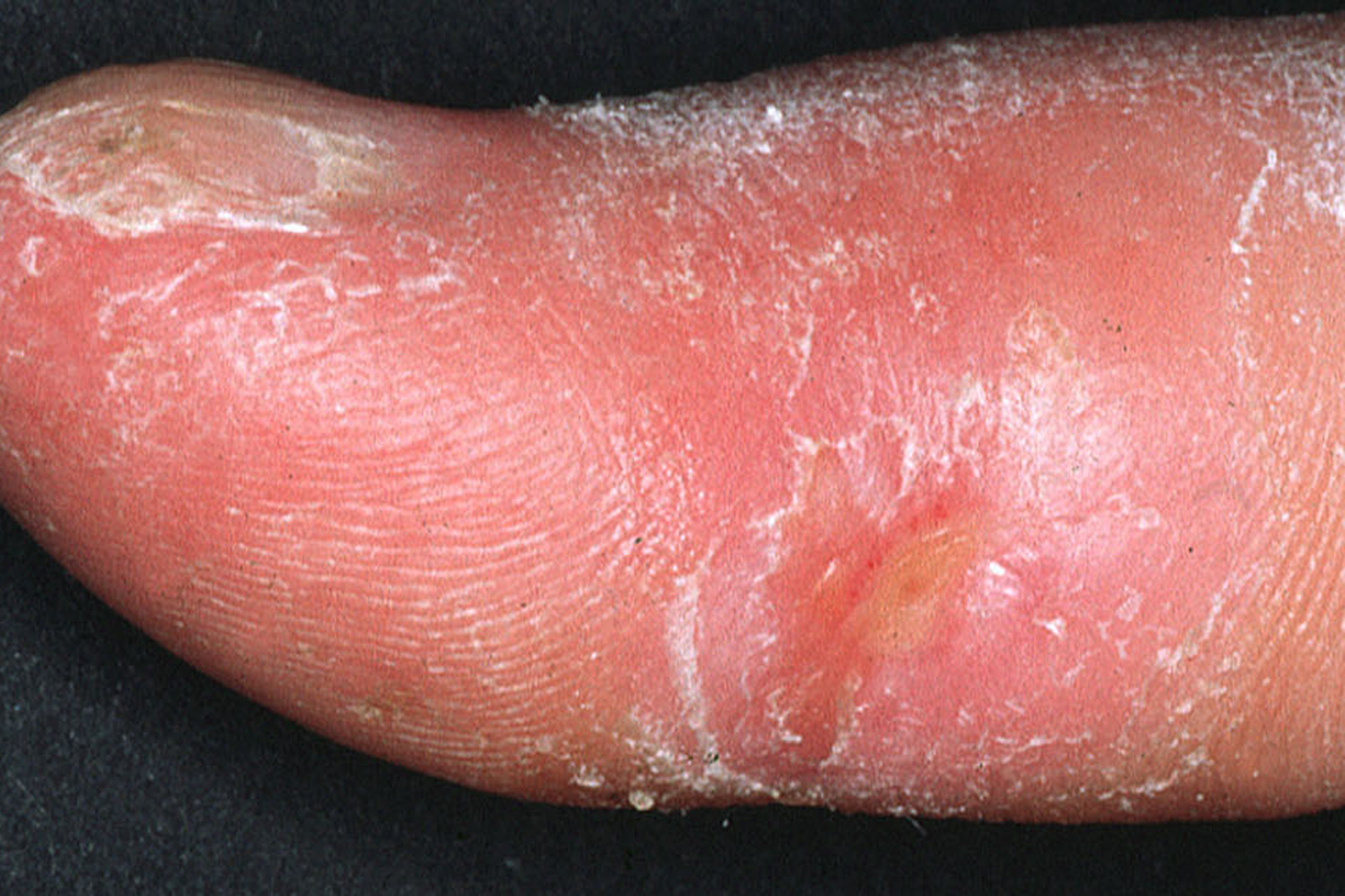 Scleroderma (Crest Syndrome): Overview, Symptoms, Causes & Care