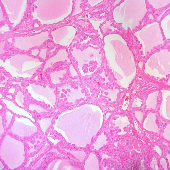 Goiter: Understanding Enlarged Thyroid Glands, Causes, and Treatments