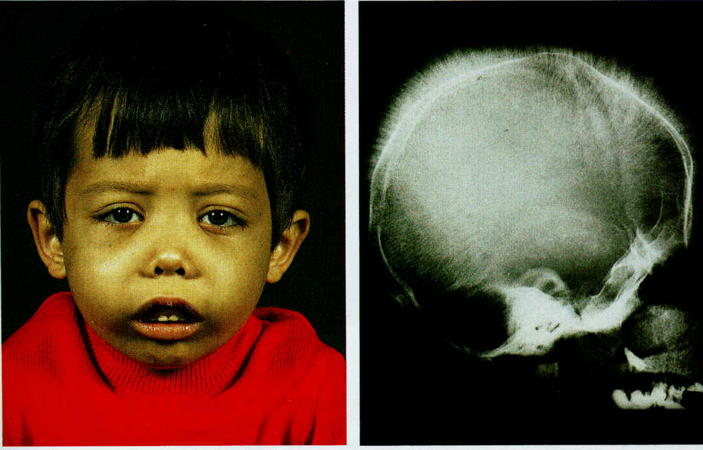 Thalassemia: Types, Causes, Symptoms, and Treatments