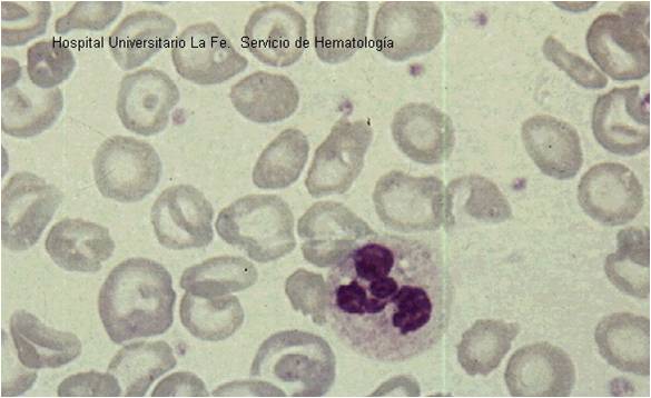 Thalassemia: Types, Causes, Symptoms, and Treatments