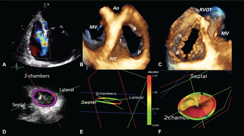 Tricuspid Valve Regurgitation: Causes, Symptoms, Diagnosis, and Treatment
