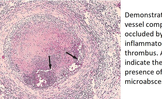 Buerger’s Disease (Thromboangiitis Obliterans): Overview, Symptoms, and Treatment