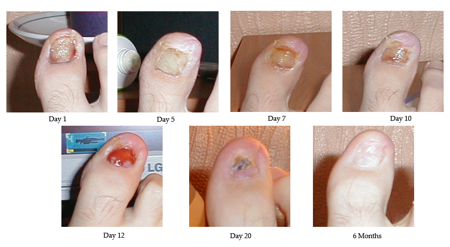 Ingrown Toenail: Causes, Symptoms, and Treatment Options