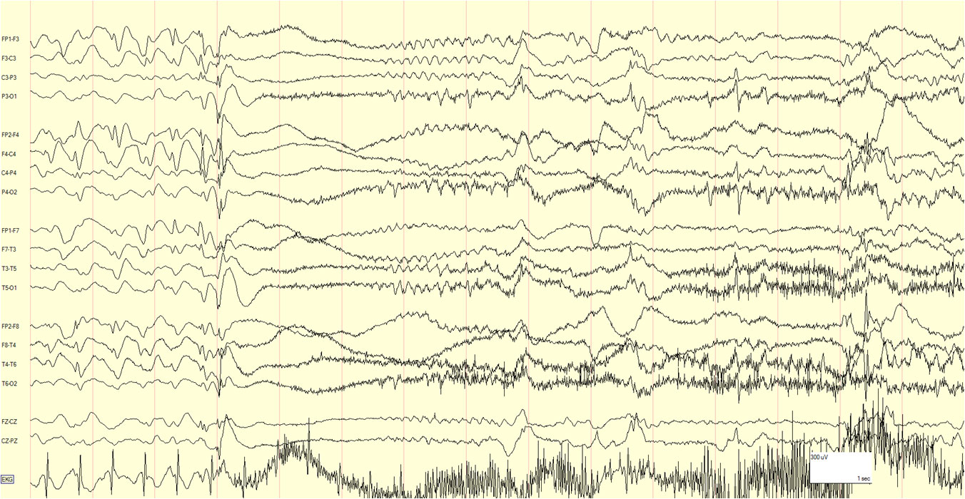 Grand Mal Seizure (Tonic-Clonic Seizure): Overview, Triggers, and Management