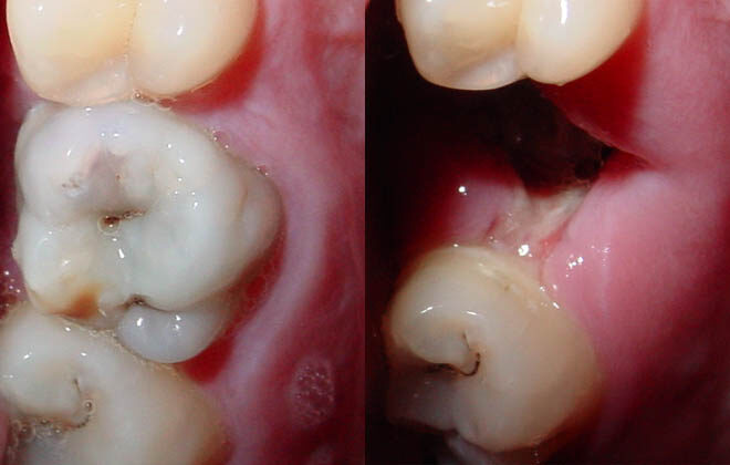 Dry Socket: Causes, Symptoms, and Care