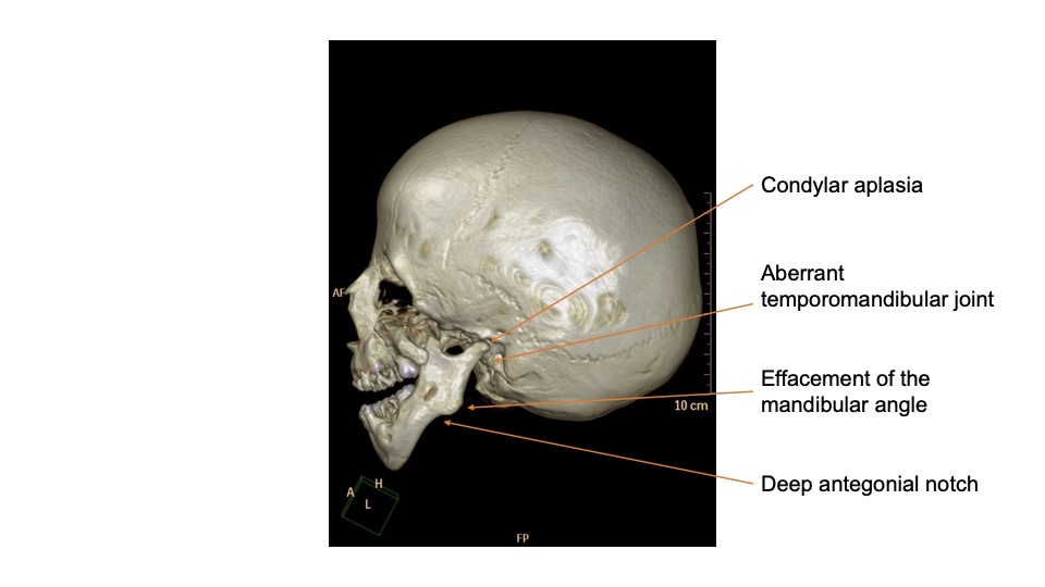 Treacher Collins Syndrome: A Detailed Overview of Facial Bone Development Disorder (TCS)