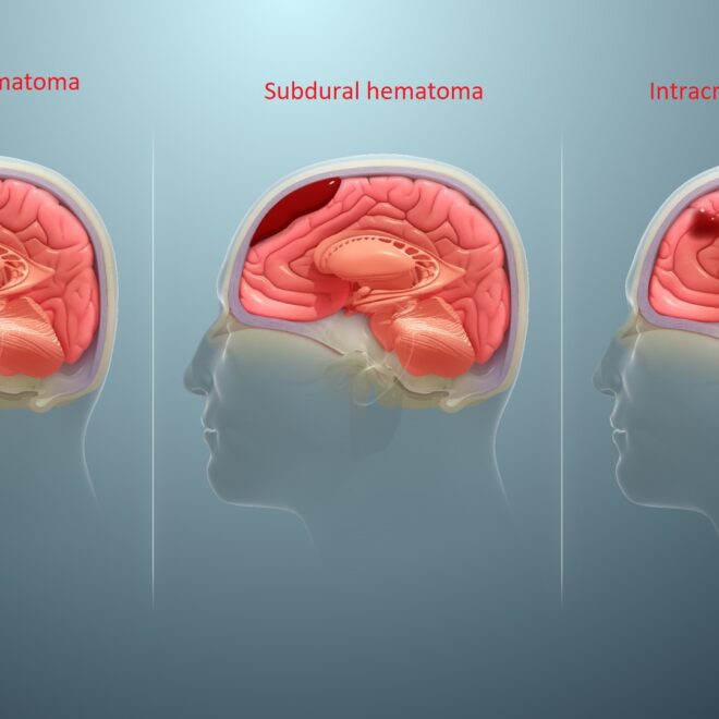 Subdural Hematoma: Causes, Symptoms, Diagnosis, and Treatment