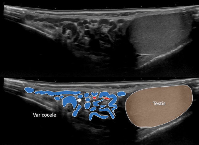Varicocele: Overview, Symptoms, Diagnosis & Treatment Options