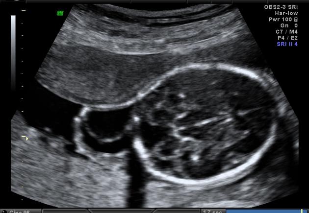 Turner Syndrome: A Complete Overview of Symptoms, Diagnosis, and Treatment
