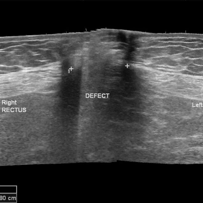 Umbilical Hernia: Causes, Symptoms, Diagnosis, and Treatment Options