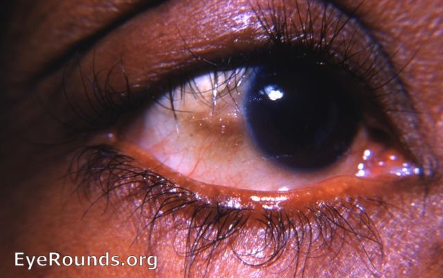 Trachoma: Causes, Symptoms, Prevention, and Treatment