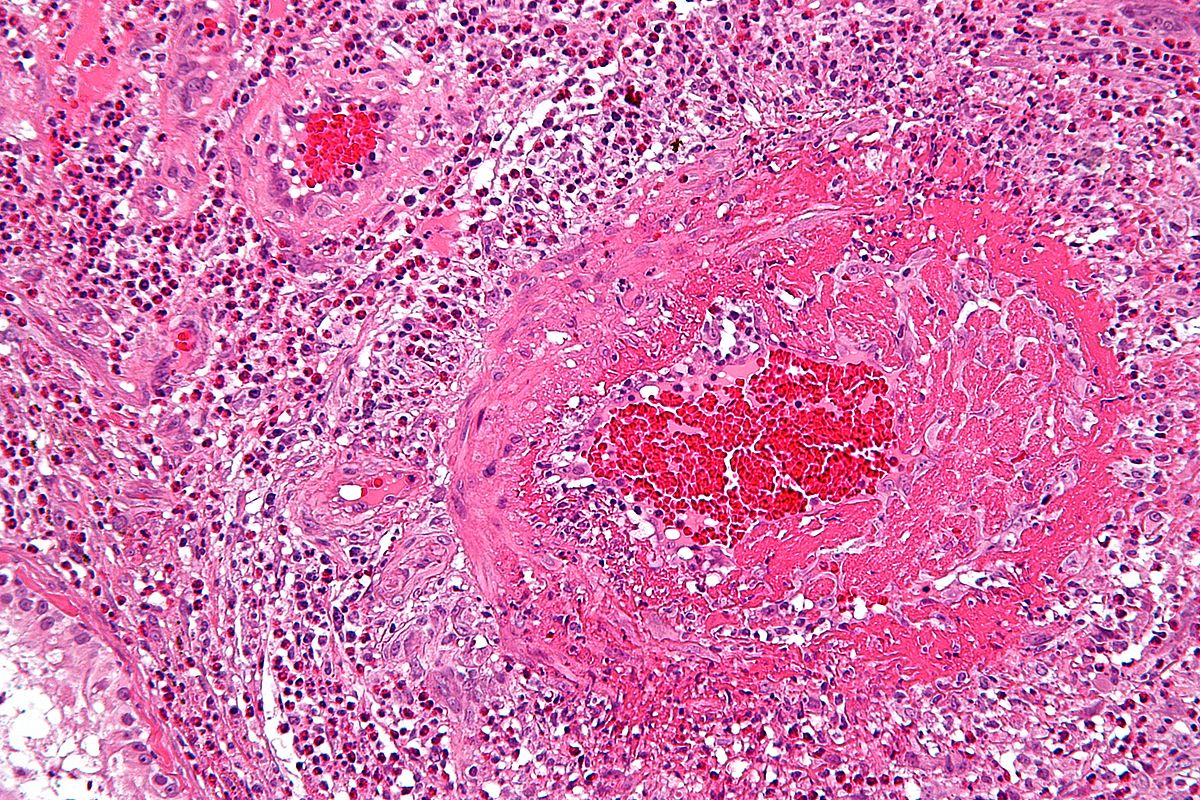 Takayasu's Arteritis (Inflammation of Large Arteries): Overview, Symptoms, Diagnosis & Care