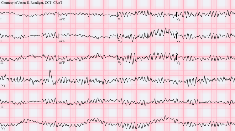 Ventricular Fibrillation: Causes, Symptoms, and Emergency Care