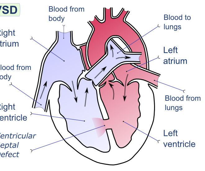 Ventricular Septal Defect (Hole in the Heart): Overview, Causes, Symptoms & Care
