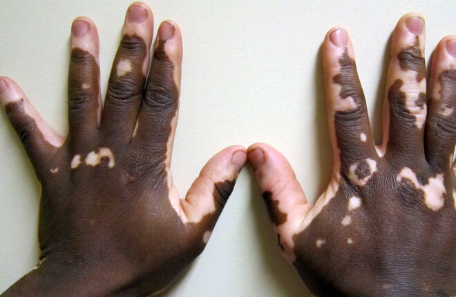 Vitiligo: Understanding the Skin Pigmentation Disorder