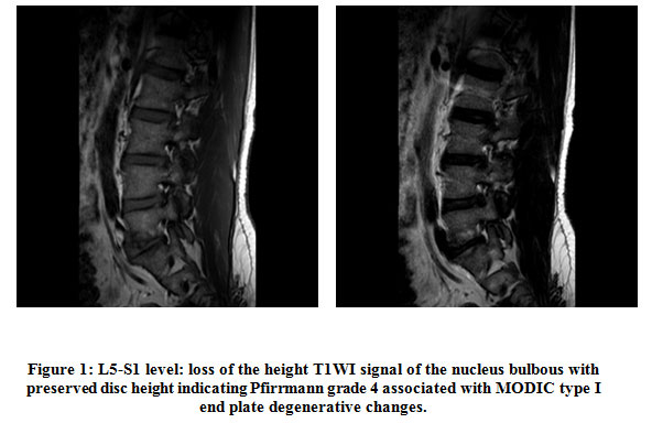 Degenerative Disc Disease: Overview, Causes, Symptoms & Care Options