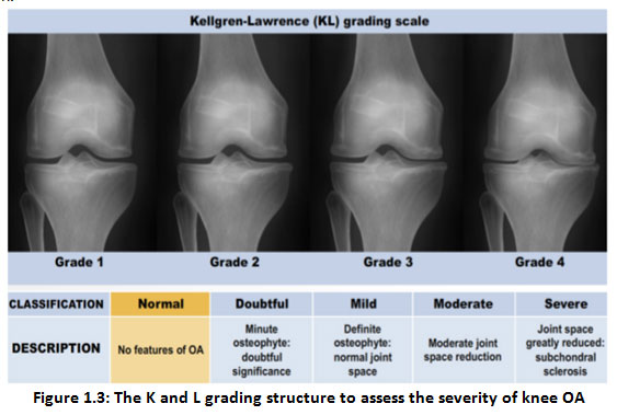 Knee Effusion (Swollen Knee): Causes, Symptoms, and Treatments