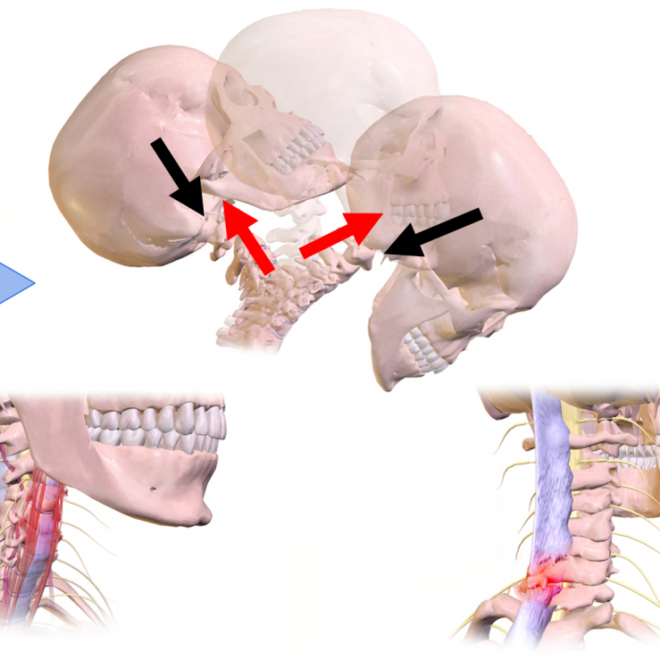 Whiplash Injury: Causes, Symptoms, Diagnosis, and Treatment Options