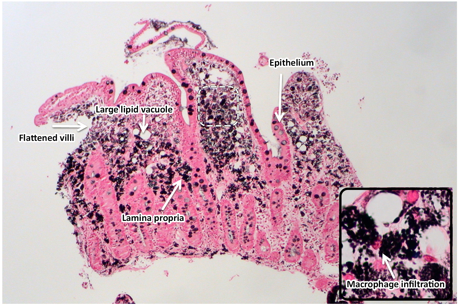 Whipple's Disease: A Comprehensive Overview of Symptoms, Diagnosis, and Treatment