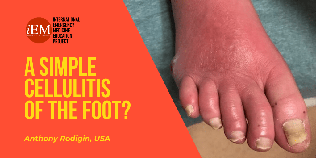 Cellulitis: Causes, Symptoms, and Treatments